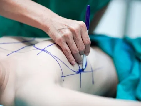 Vì sao cần chọn đúng size túi khi nâng ngực