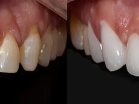 Xu hướng răng sứ, công nghệ tại Nha khoa Hoa Hồng Phương Đông