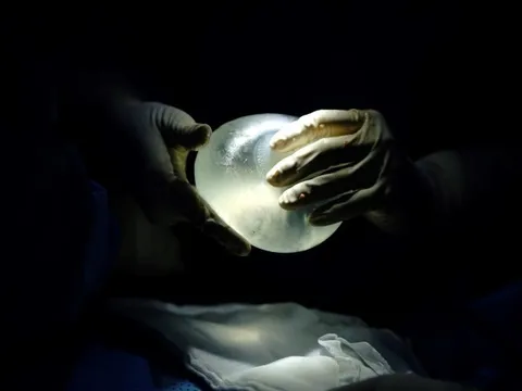 Nguyên nhân gây giả bao xơ sau nâng ngực