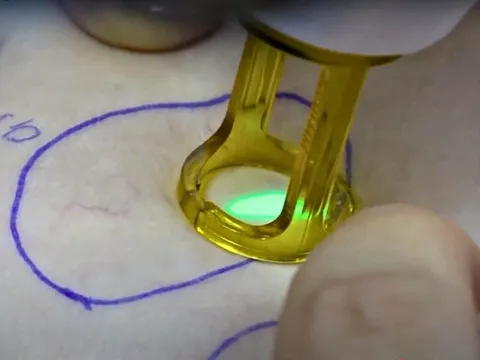 Phương pháp điều trị suy giãn tĩnh mạch nông độ 1