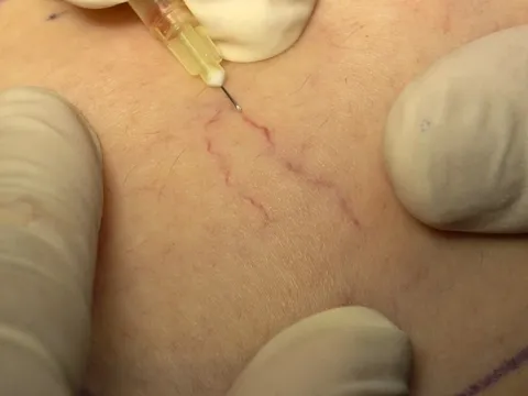 Ưu nhược điểm của các phương pháp điều trị giãn tĩnh mạch