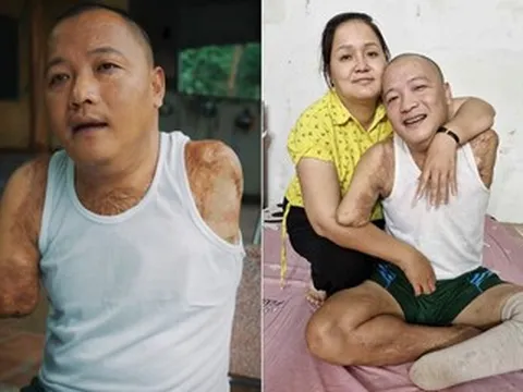 Mất 2 tay 1 chân sau tai nạn, người đàn ông tìm lại cuộc đời nhờ tình yêu của vợ