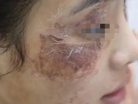 Cô gái bị tàn phá dung nhan vì bôi kem mua trên mạng