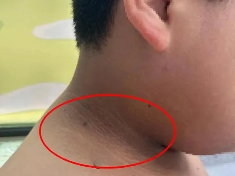 Mẹ phát hiện trên cổ, nách và đùi con trai dậy thì có những "vạch màu đen" kỳ lạ, bác sĩ cảnh báo nguy hiểm