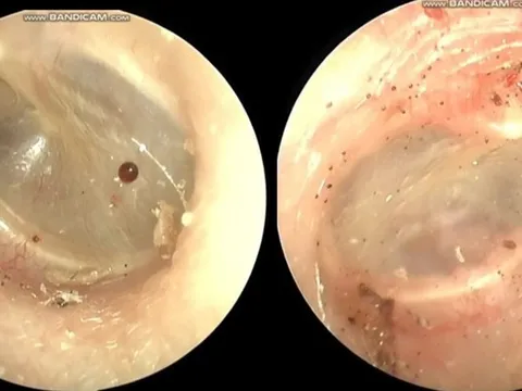 Người phụ nữ 60 tuổi tai ngứa như kim châm, bác sĩ gắp ra thứ "đáng sợ" bên trong