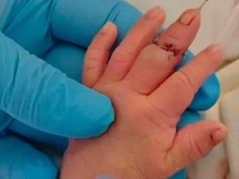 Nữ hộ sinh làm đứt ngón tay bé trai khi cắt dây rốn