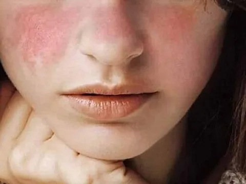 Để da không bị khô, sần sùi mùa lạnh