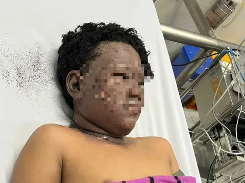 Bé trai với gương mặt cháy đen tự chạy về nhà để người thân đưa đi bệnh viện