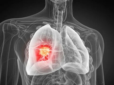 Phát hiện nguyên nhân gây ung thư phổi chưa từng biết