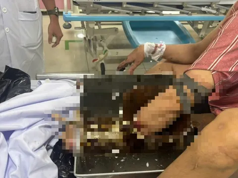 Người đàn ông vác cả máy xay thịt đến bệnh viện cấp cứu