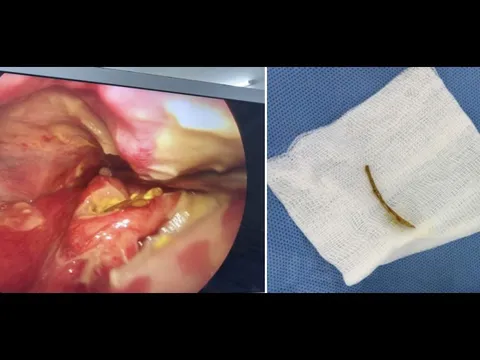 Ngậm viên sủi C để chữa hóc xương cá, người phụ nữ nguy kịch