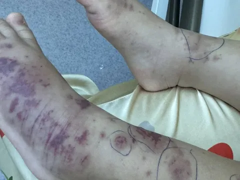 Chuyên gia cảnh báo về một căn bệnh nguy hiểm, lây lan nhanh, tỉ lệ tử vong cao