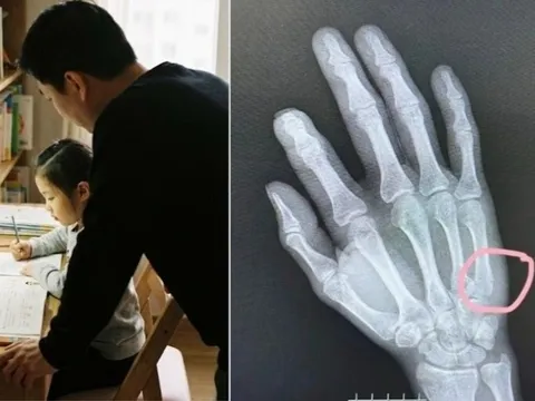 Kèm con làm bài tập về nhà, bố tức giận đập bàn gãy tay