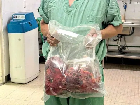 Lần đầu tiên tại Việt Nam: Cắt bỏ hai thận đa nang nặng gần 10kg, ghép thận thành công trong một ca mổ