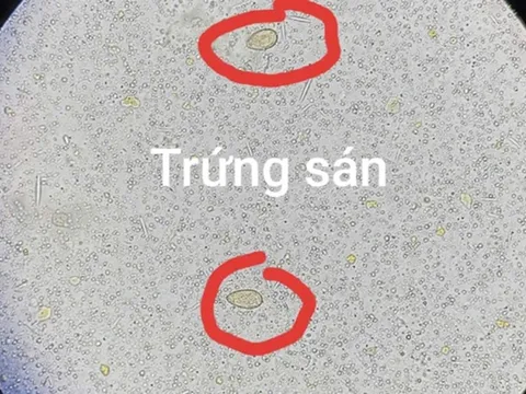 Đau bụng đi khám, người đàn ông 64 tuổi sốc ngang khi thấy ở sán trong người