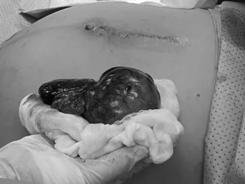 Thai 34 tuần, phát hiện u buồng trứng chèn ép