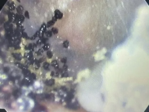 Nghe thấy âm thanh lạ trong tai, bé 7 tuổi đi khám thì sốc nặng