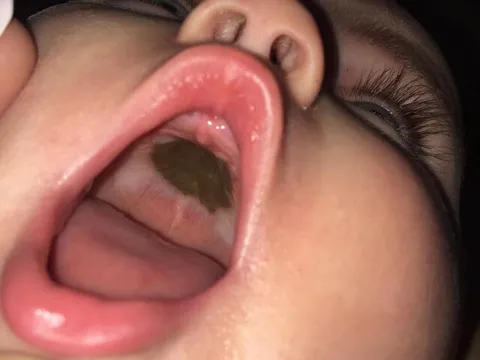 Mẹ phát hoảng thấy miệng con xuất hiện đốm đen lạ, đến bệnh viện nghe bác sĩ chúc mừng mà xấu hổ