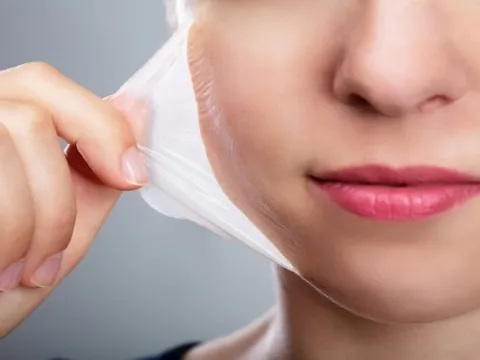 Những điều cần lưu ý trước khi thực hiện kỹ thuật peel da