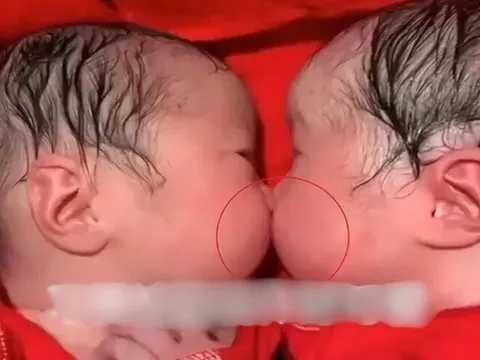 Vừa chào đời cặp chị em song sinh dính chặt nhau không rời, bác sĩ đỡ đẻ nhìn mẹ lắc đầu: “Ca này lạ quá”