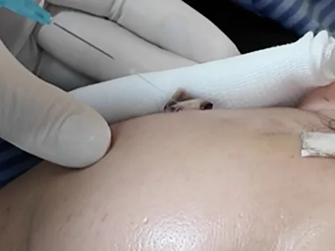 Căng chỉ da mặt tại spa, người phụ nữ gặp biến chứng nặng