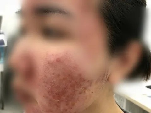 Cơn ác mộng của thiếu nữ chỉ sau vài giờ được mời làm đẹp cấp tốc đón Tết