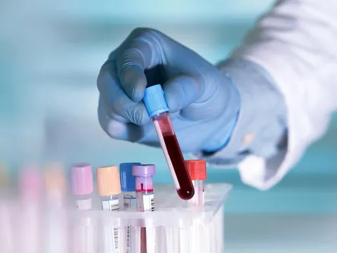 Xét nghiệm ung thư mới từ Mỹ có thể cứu nhiều người