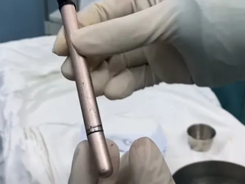 Thiếu nữ dùng cây bút gãi ngứa vùng kín rồi bị mắc kẹt trong bàng quang