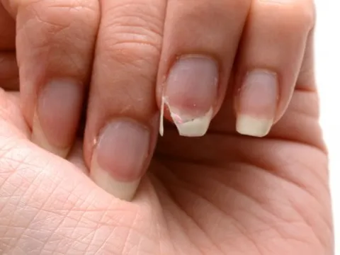Cách chăm sóc và phục hồi móng tay yếu, dễ gãy