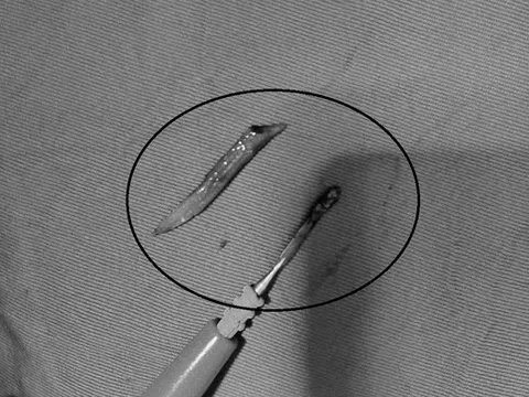 Người đàn ông 41 tuổi đau bụng, bác sĩ sốc phát hiện ra thứ đáng sợ "đi lạc" trong bụng