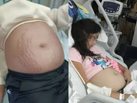 Bé gái lớp 9 bụng phình to như mang bầu, bác sĩ khám cho đứa trẻ nói 3 từ khiến mẹ kinh hãi ngã quỵ