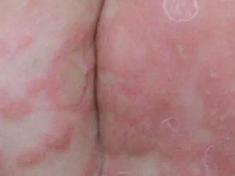 Bé trai 3 tuổi bị giang mai bẩm sinh dù không có triệu chứng