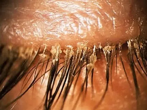 Người phụ nữ 24 tuổi khó chịu ở mí mắt, bác sĩ sốc khi gắp ra thứ "đáng sợ" chi chít trên mi