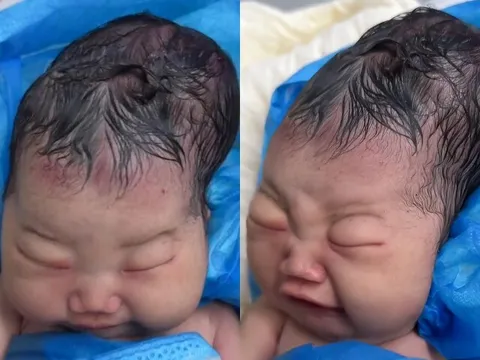 Bé gái sơ sinh chào đời với cái đầu nhọn, bố sợ hãi không nhận con, bác sĩ báo tin vui