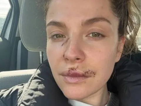 Nữ diễn viên 37 tuổi lộ gương mặt đầy vết thương sau vụ bị chó cắn