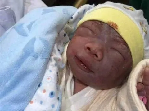 Mẹ muốn khóc khi con sơ sinh chào đời tím tái như “củ khoai môn”, 3 tháng sau “lột xác” xinh như búp bê
