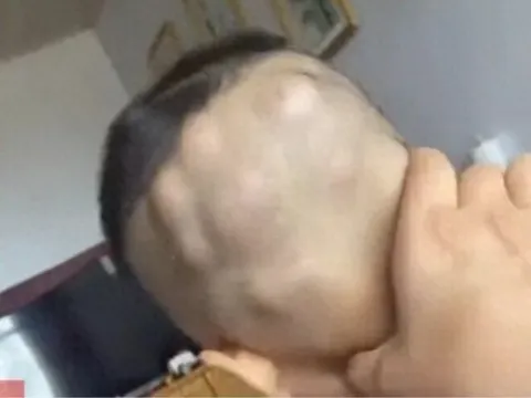 Mẹ tắm cho con 6 tuổi thì điếng người phát hiện đầu bé mọc đầy khối u to, đến bệnh viện bác sĩ nói: Thật hiếm gặp!