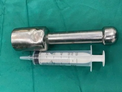 Thiếu niên 15 tuổi mắc kẹt chày kim loại dài 18 cm ở trực tràng