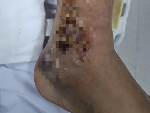 Đắp thuốc, một người đàn ông suýt mất chân