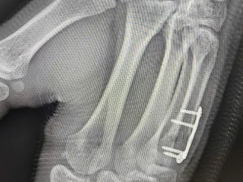 Nam sinh gãy xương bàn tay sau cú đấm boxing