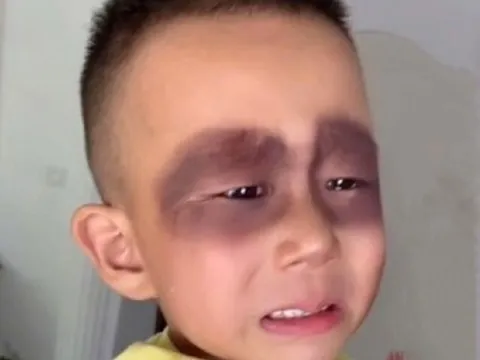 Bé trai 5 tuổi ngủ dậy khóc thét vì mặt bỗng bầm tím, nguyên nhân từ thói quen tai hại mỗi ngày