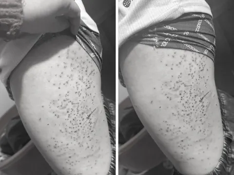 Học sinh lớp 7 bị bạn dùng bút bi đâm chi chít vào đùi