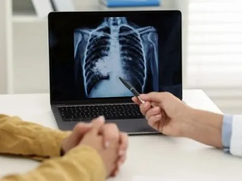 TPHCM sẽ triển khai chiến dịch 100 ngày sàng lọc lao chủ động trong cộng đồng