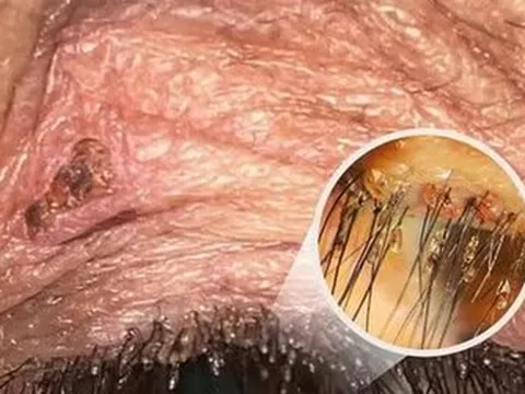 Ngứa mắt khó chịu, người bệnh sốc khi bác sĩ tìm thấy “thủ phạm” ở bờ mi