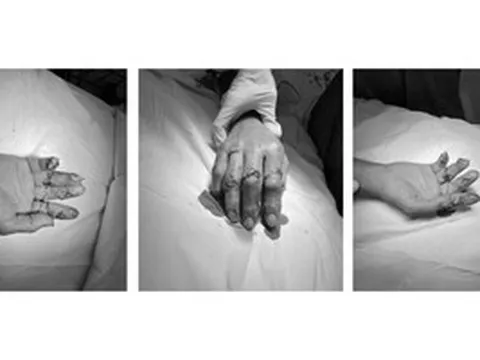 Xuyên đêm nối lại 4 ngón tay đứt rời cho người đàn ông bị tai nạn máy cắt