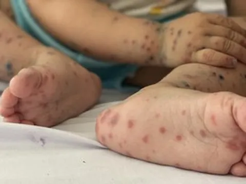 Tay chân miệng tăng mạnh, trẻ em chiếm hơn 99% ca mắc