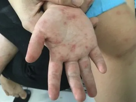 Làm gì để giảm nguy cơ tử vong và di chứng do bệnh tay chân miệng?
