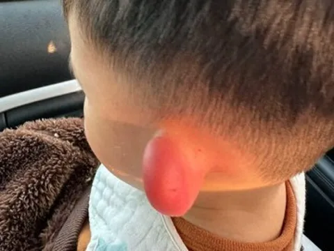 Con qua nhà hàng xóm chơi, về nhà lỗ tai bỗng sưng vù biến dạng, đưa vào viện bác sĩ khen mẹ giỏi