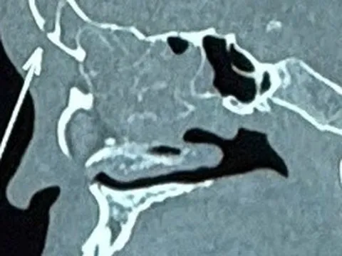 Tưởng chỉ viêm xoang đơn giản, nam thanh niên suýt mất mạng vì bị biến chứng