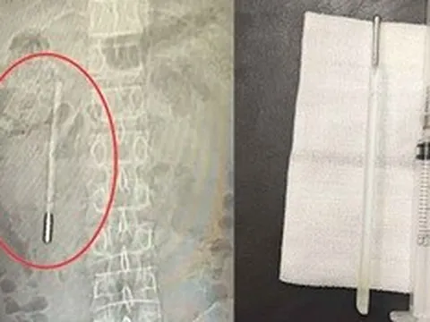 Đau bụng đi khám, người đàn ông sốc nặng khi thấy thứ bên trong